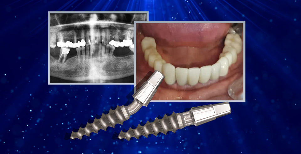 Minimizing Peri-Implantitis Risk with the DSI One-Piece Compressive Implant