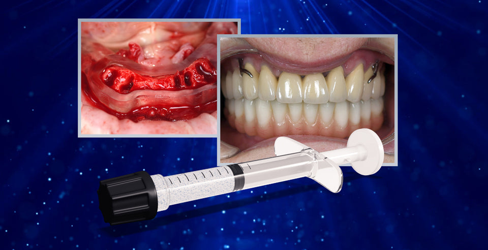 DSI Alyoss Plus- Bone-Grafting