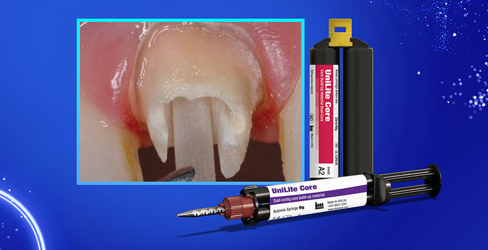 DSI UniLite Core- Dual-Cured Radiopaque Composite