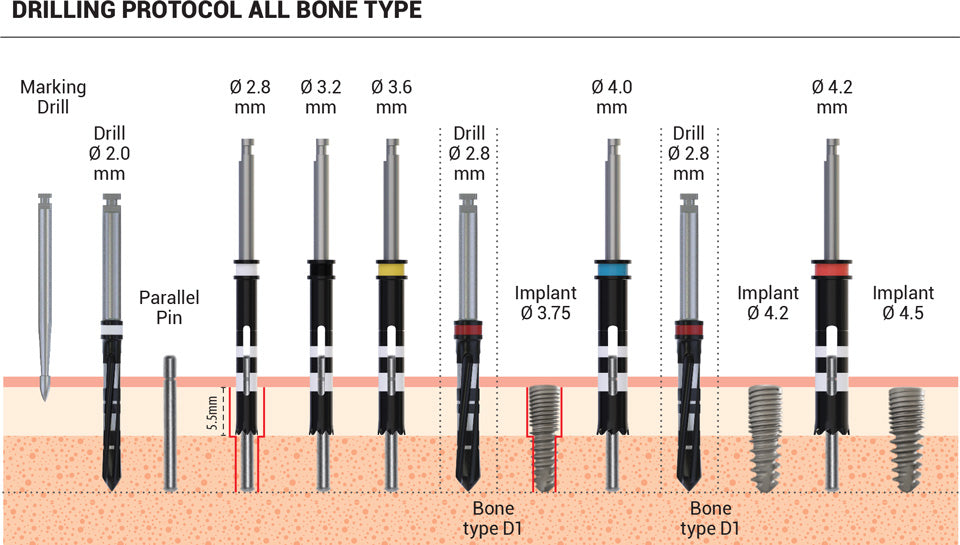 DSI Smart Dual Thread Spiral Implant - Internal Hex