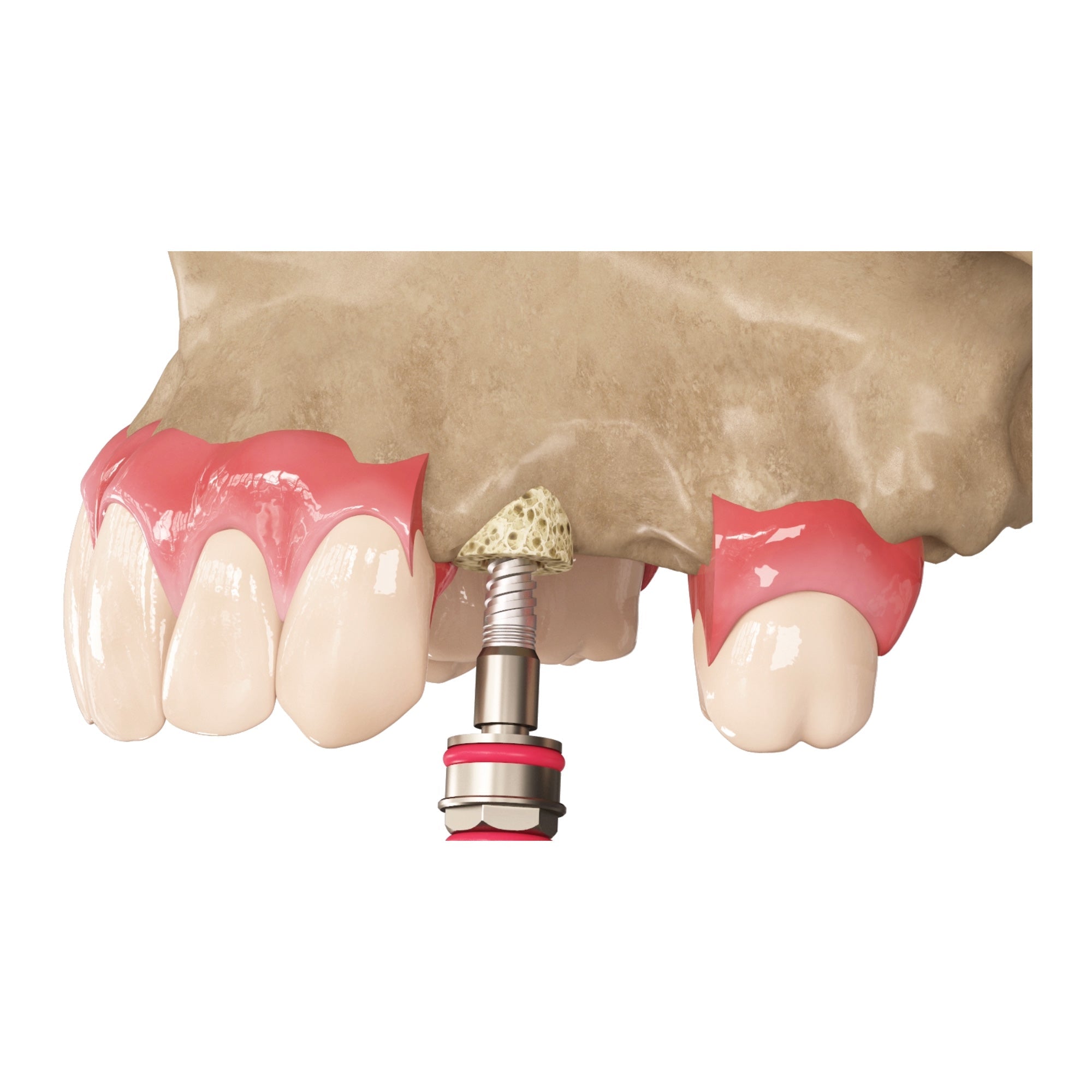 DSI Zenoss Bovine Natural Bone Graft Ring For Single Stage Implantation