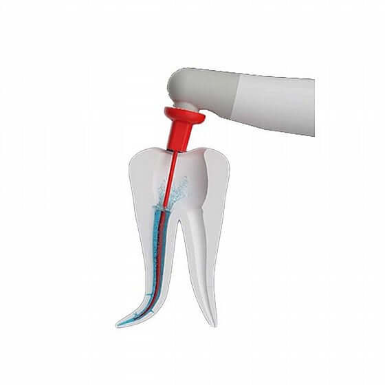 Endodontischer Aktivator zur Reinigung und Spülung von Wurzelkanälen