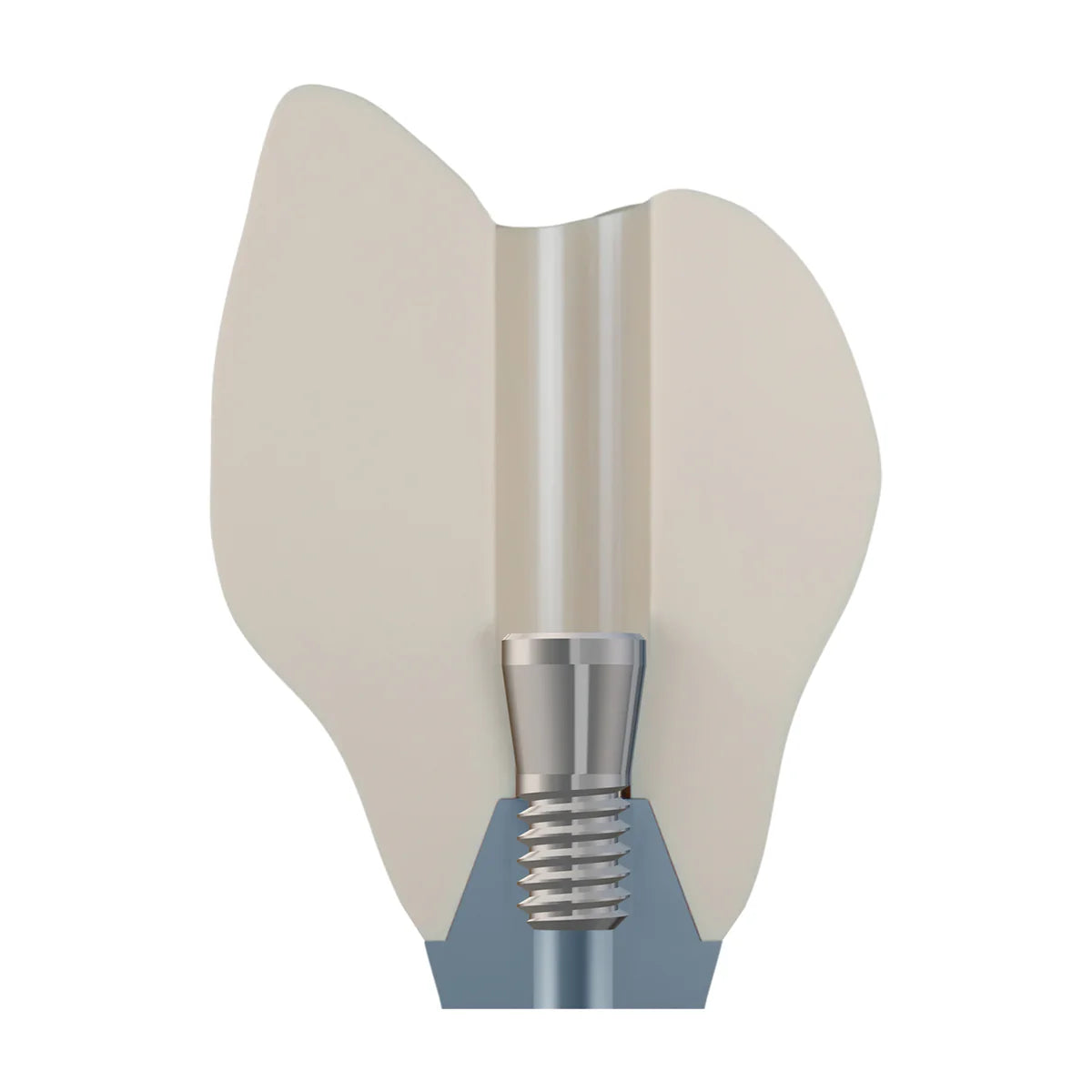 DSI EvoConnect - Direct Сonnection Screws for Multi-Unit Abutments M1.4